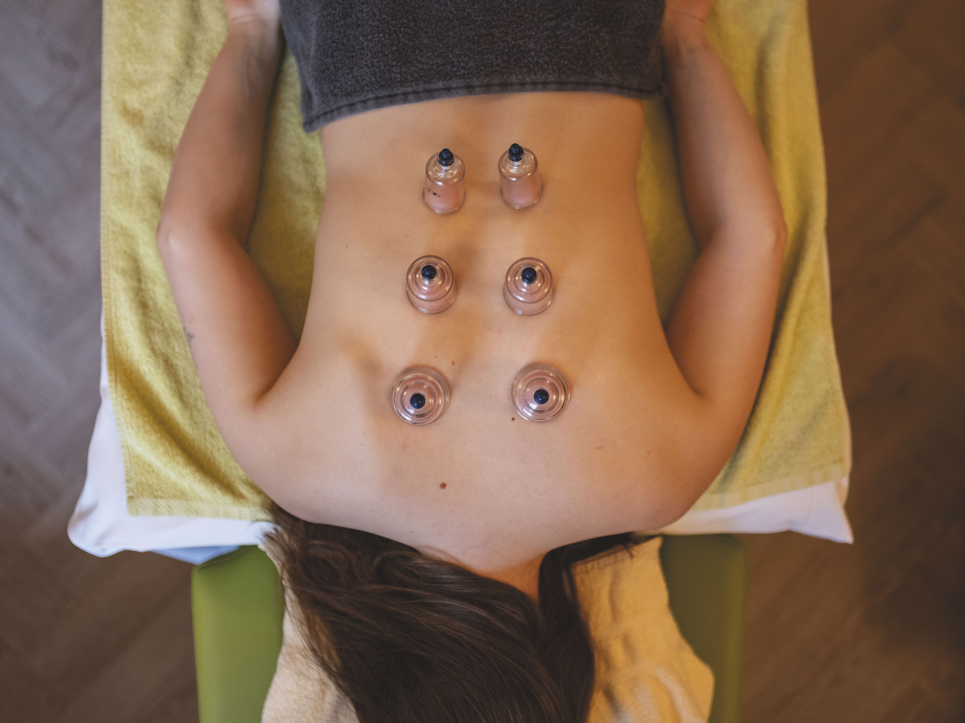 A person is lying on their stomach with cupping glasses on their back.